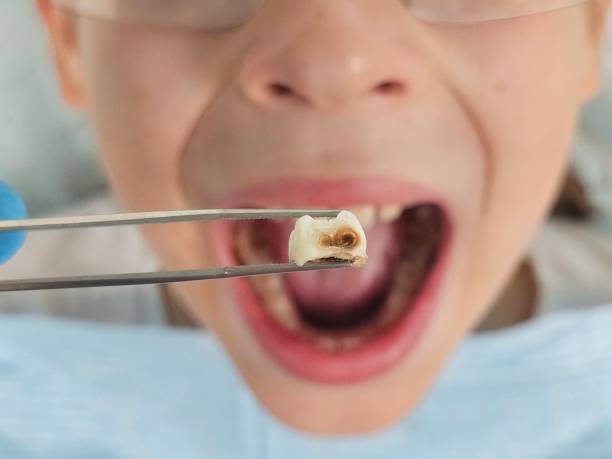 Best Emergency Dental Filling Replacement  in Milford, IN